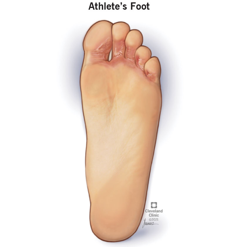 Understanding Athlete’s Foot and Home Remedies