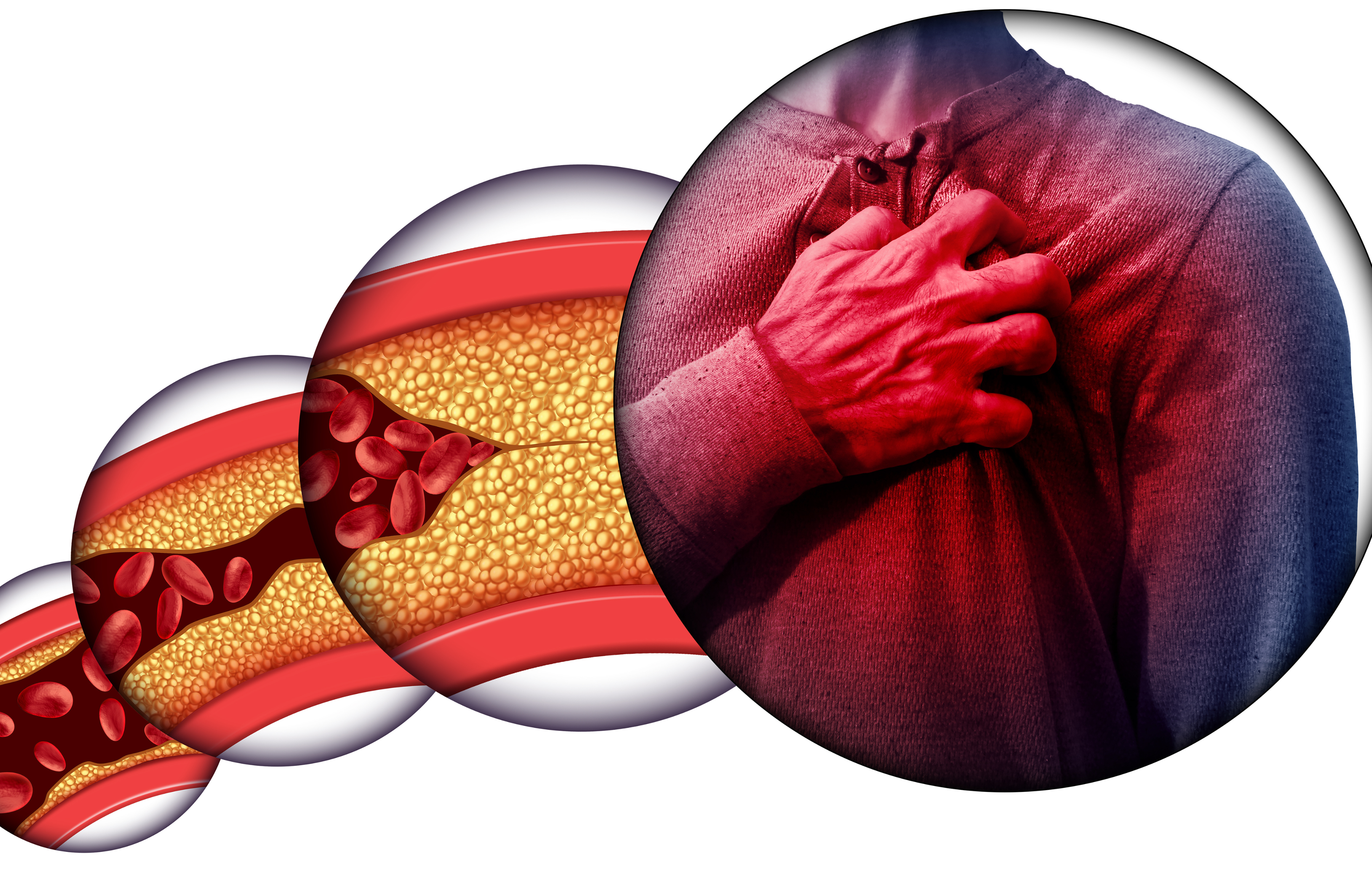 Rising Cases of Cardiovascular Disease Among Young People in Guyana